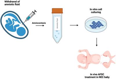 Amniotic fluid stem cells: A novel treatment for necrotizing enterocolitis